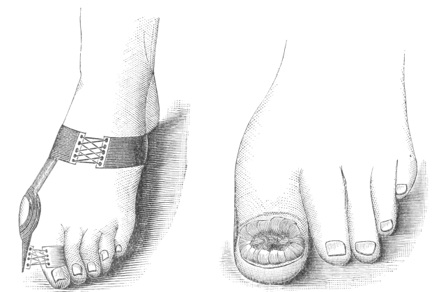 Schwarze und weiße Zeichnung von zwei Füssen, einer mit Verband und der andere mit einer sichtbaren Fraktur, mit Text, der die Behandlung angibt.